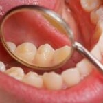 تشخیص و درمان سرطان دهان در مراحل مختلف