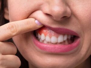 سرطان دهان در کودکان چگونه است؟