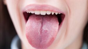 علائم سرطان زبان چیست ؟