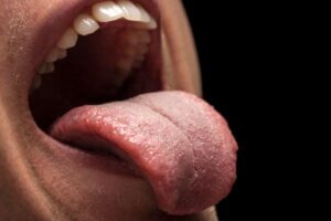 علائم سرطان زبان چیست؟