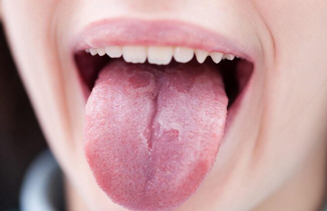 سرطان زبان راهبردهای تشخیص زودهنگام و پیشگیری