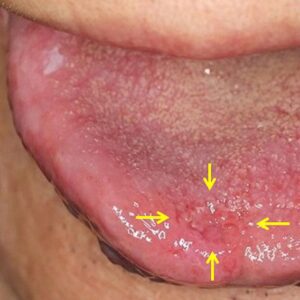 انواع سرطان زبان