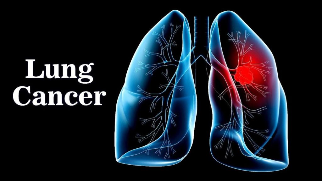 سرطان ریه ارتباط با سایر بیماری ها و عوارض جانبی