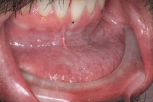 علت ‌ایجاد سرطان دهان