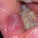 عوامل خطر سرطان دهان و روش‌های پیشگیری از آن