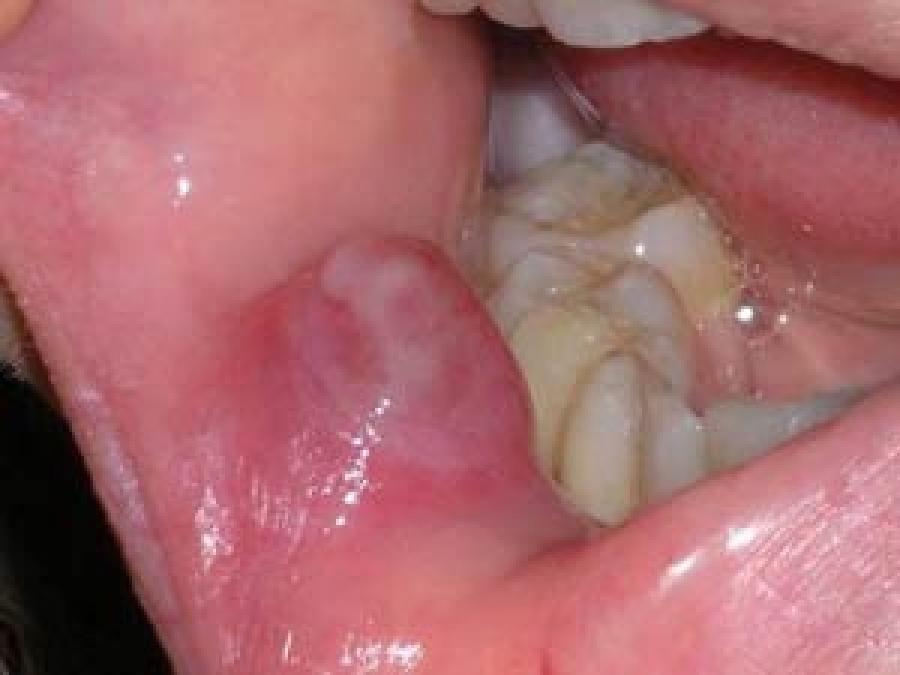 عوامل خطر سرطان دهان و روش‌های پیشگیری از آن