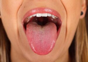 انواع سرطان دهان