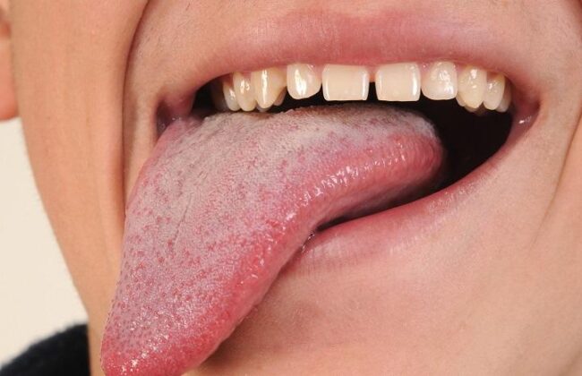قاتل خاموش نگاهی به سرطان زبان و افزایش شیوع آن