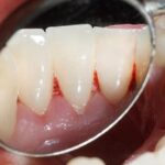 اهمیت بهداشت دهان و دندان در پیشگیری از سرطان زبان
