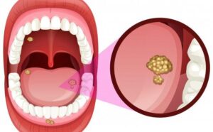 چه افرادی بیشتر در معرض مبتلا شدن به سرطان دهان هتسند؟