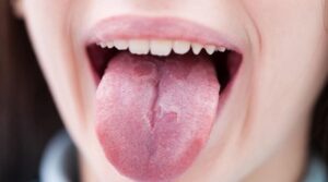 نحوه تشخیص سرطان زبان