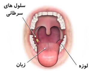 عوامل خطر و علل سرطان زبان