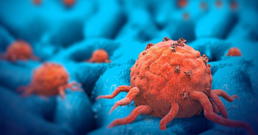سرطان گونه: تشخیص و درمان در مراحل مختلف