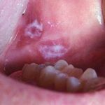 شناخت و پیشگیری از سرطان دهان و لثه